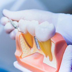 Dentist pointing to model of dental implants in Shelton, CT