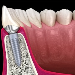 Illustration of dental implants placed in lower jaw