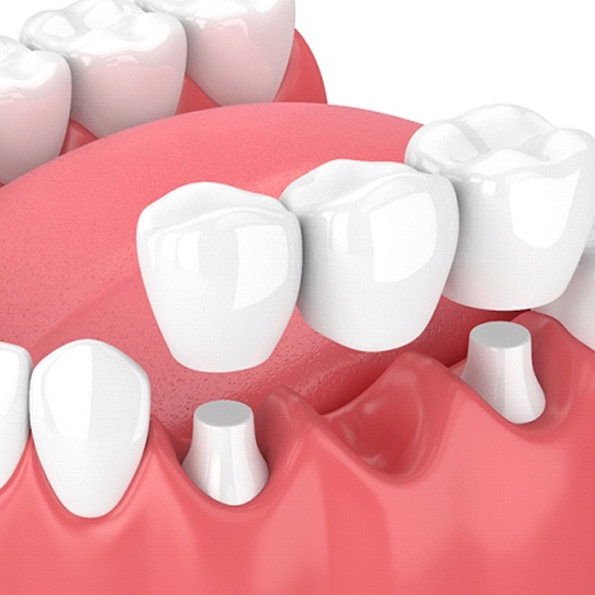 Digital model showing a dental bridge and crowns