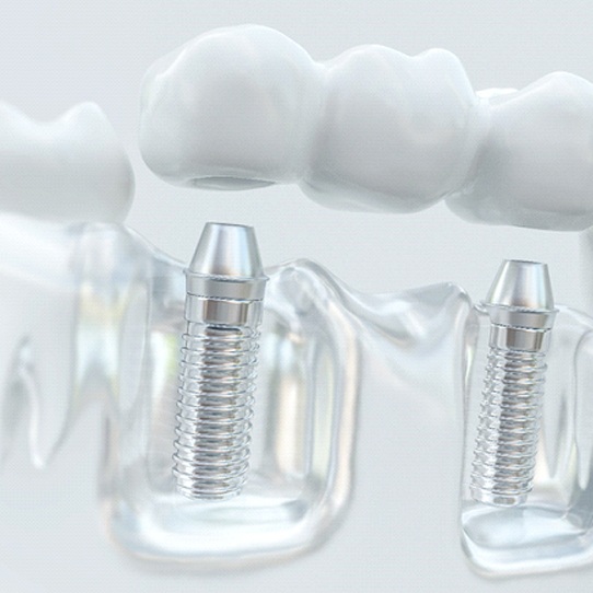 Model of an implant supported bridge