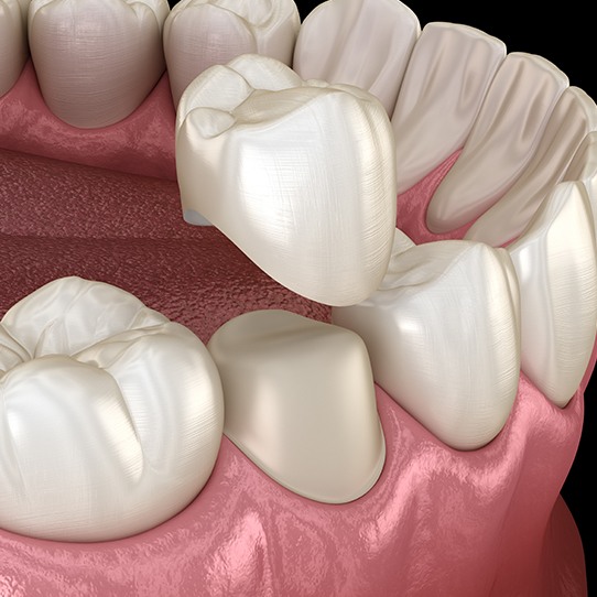 Animated dental crown placement