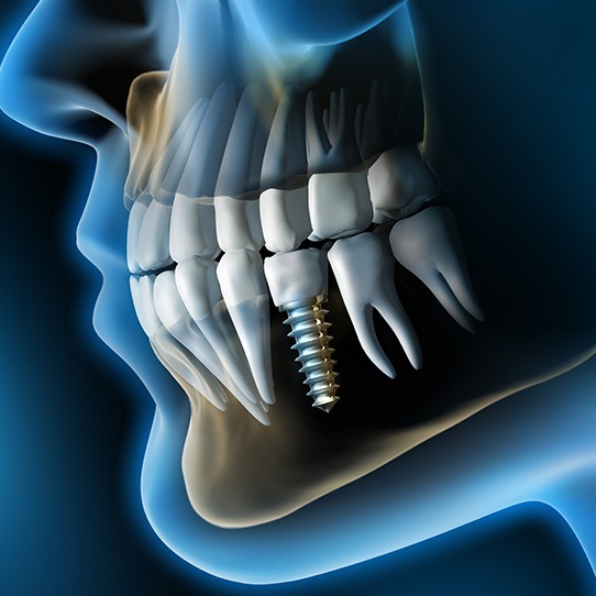 Animated smile with dental implant supported replacement tooth