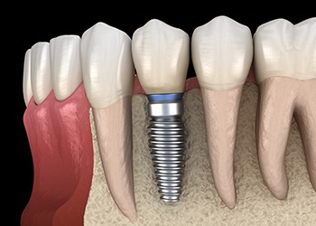 Animated dental implant supported dental crown