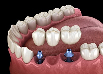 Animated dental implant supported fixed bridge