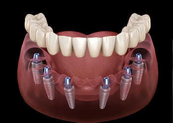 Animated dental implant supported denture