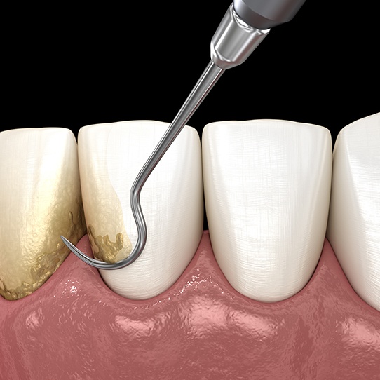 Animated scaling and root planing periodontal treatment