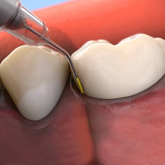 Animated arestin antibiotic therapy treatment