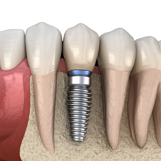 Aniamted dental implant supported dental crown