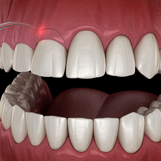 Closeup of smile during gum recontouring treatment