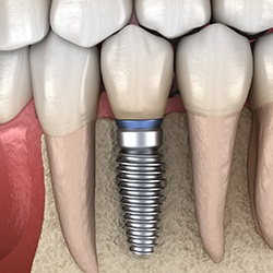 Single dental implant integrated with jaw