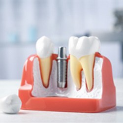 Model of a dental implant between two teeth