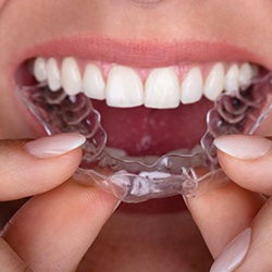 Woman inserting clear aligner