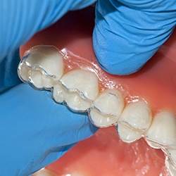 Model of clear aligner on dental mold