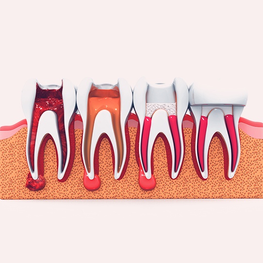 Animated tooth throughout the root canal process