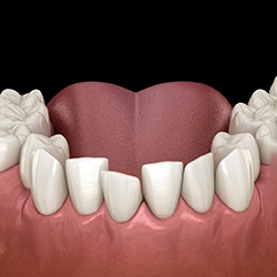 Illustration of crooked teeth against dark background