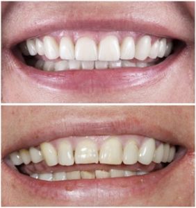 A “before and after” of a woman’s smile corrected with cosmetic dentistry