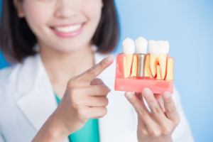 a dentist holding a dental implant model